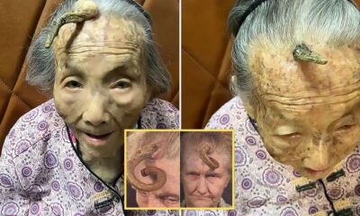 This is too risky”: 107YO went viral because the 4-inch “Longevity Horn” growing on her forehead was said to be due to… see more